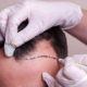 Advancement in Hair Transplantation